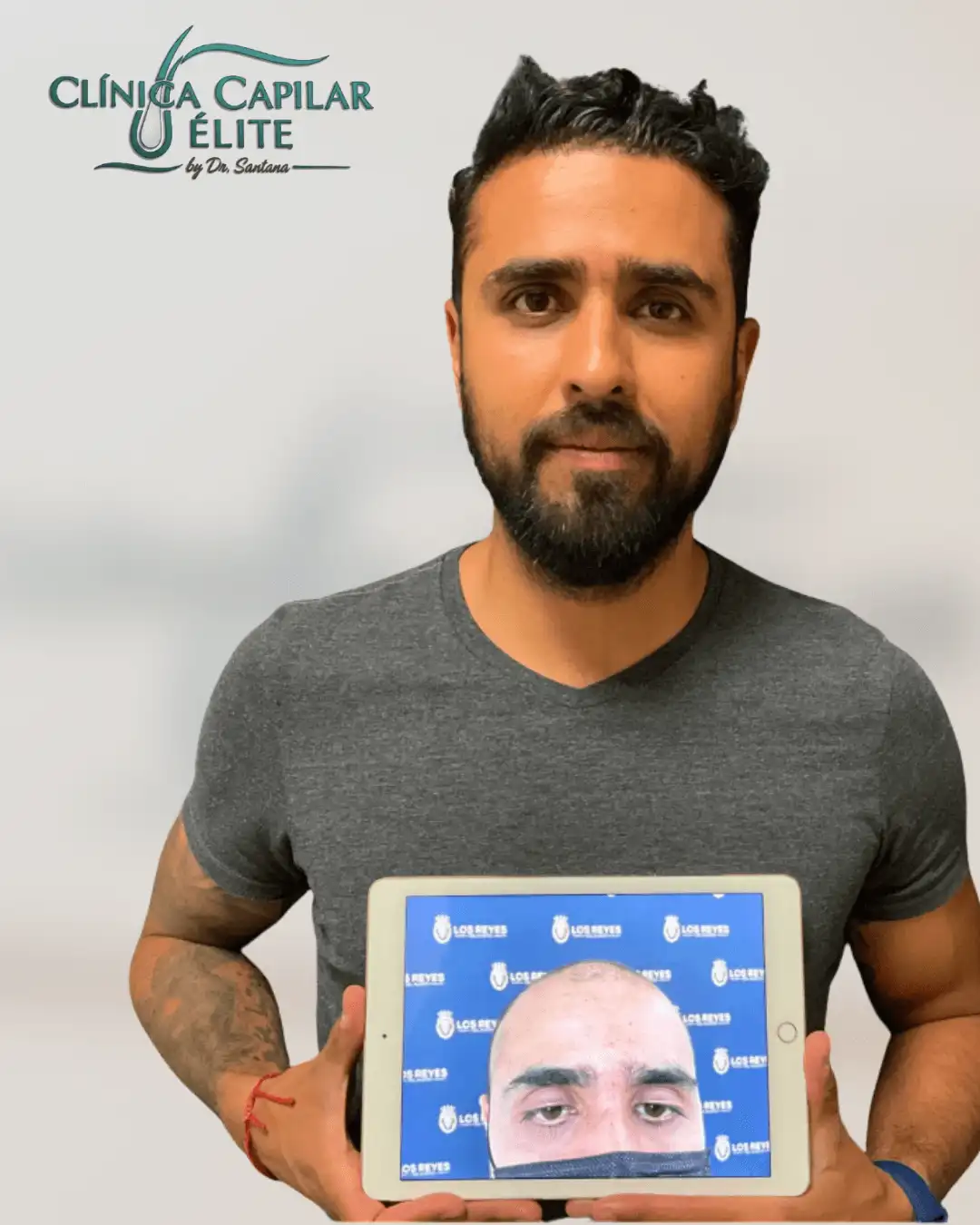 Injerto de barba