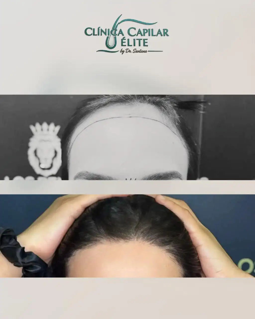 Caso complejo barba